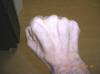 images/muscle atrophy in right hand caused by damage to the ulnar nerve-closed-fist_small.JPG - Loss of fleshy muscle between the thumb and forefinger is very noticeable with a closed fist.